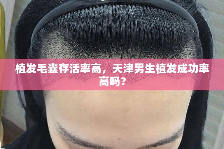 植发毛囊存活率高，天津男生植发成功率高吗？