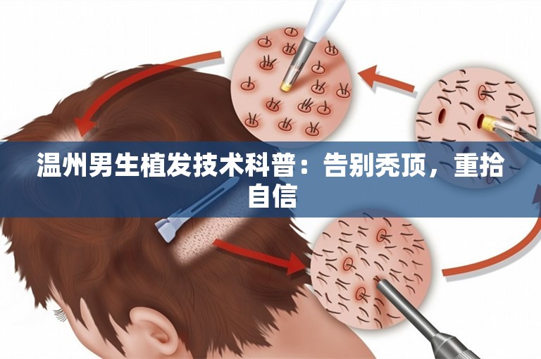 温州男生植发技术科普：告别秃顶，重拾自信