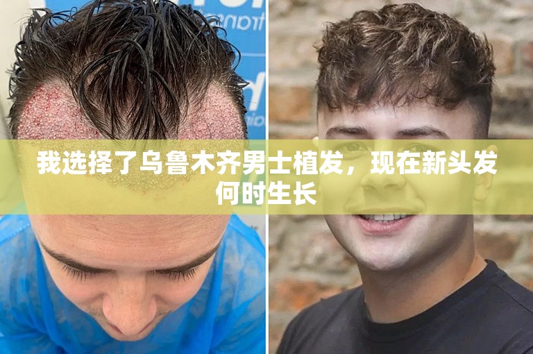 我选择了乌鲁木齐男士植发，现在新头发何时生长