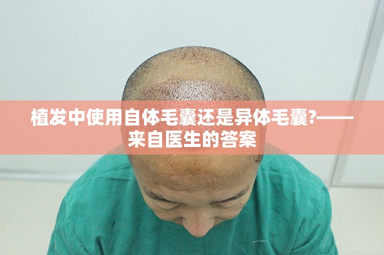 植发中使用自体毛囊还是异体毛囊?——来自医生的答案