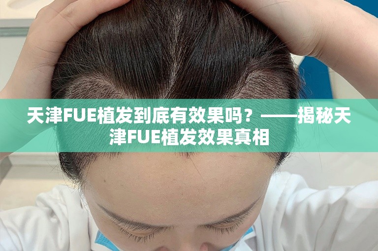 天津FUE植发到底有效果吗？——揭秘天津FUE植发效果真相