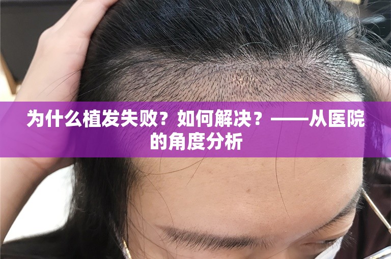 为什么植发失败？如何解决？——从医院的角度分析