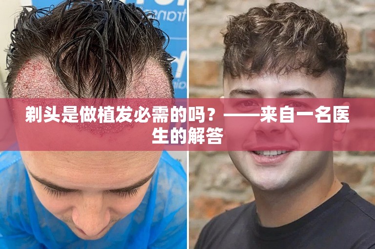 剃头是做植发必需的吗？——来自一名医生的解答