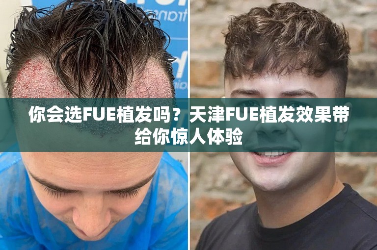 你会选FUE植发吗？天津FUE植发效果带给你惊人体验