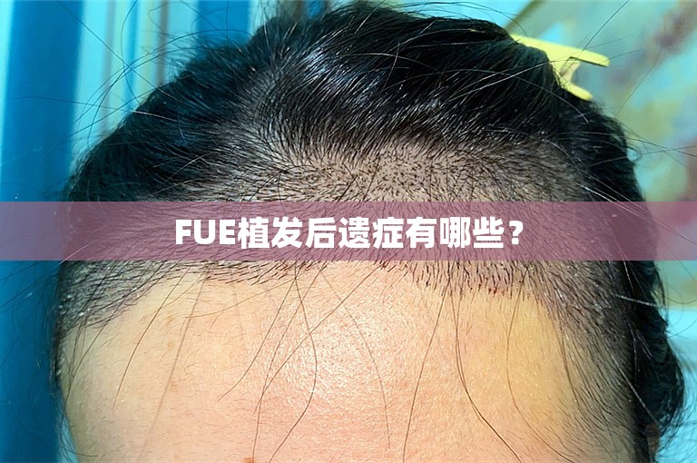 FUE植发后遗症有哪些？