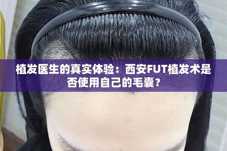 植发医生的真实体验：西安FUT植发术是否使用自己的毛囊？