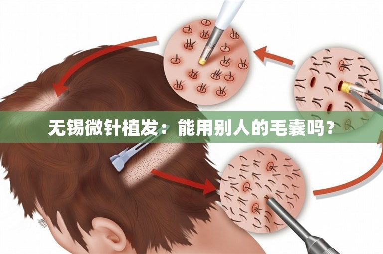 无锡微针植发：能用别人的毛囊吗？