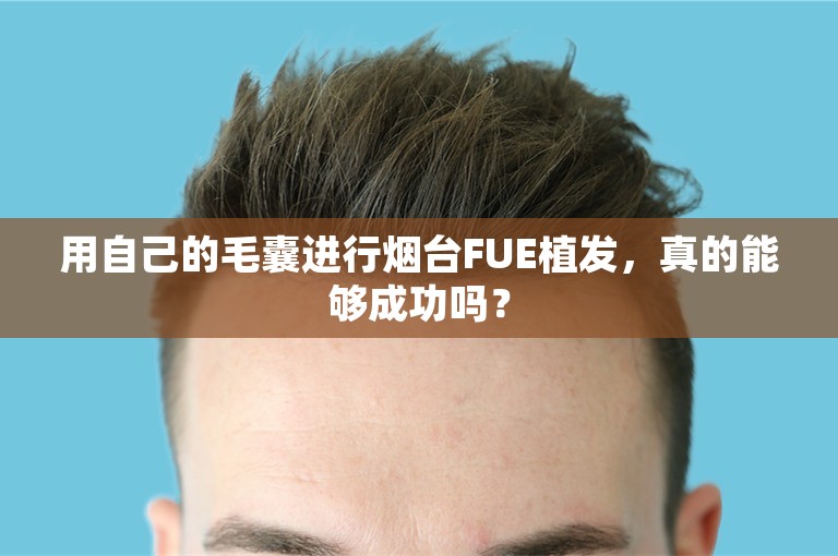 用自己的毛囊进行烟台FUE植发，真的能够成功吗？