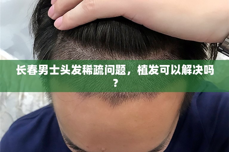 长春男士头发稀疏问题，植发可以解决吗？