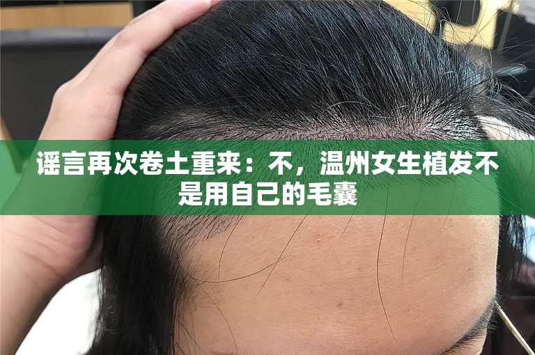 谣言再次卷土重来：不，温州女生植发不是用自己的毛囊