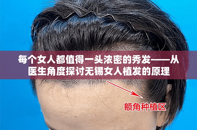 每个女人都值得一头浓密的秀发——从医生角度探讨无锡女人植发的原理