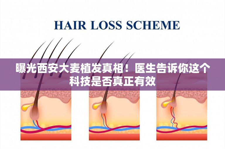曝光西安大麦植发真相！医生告诉你这个科技是否真正有效