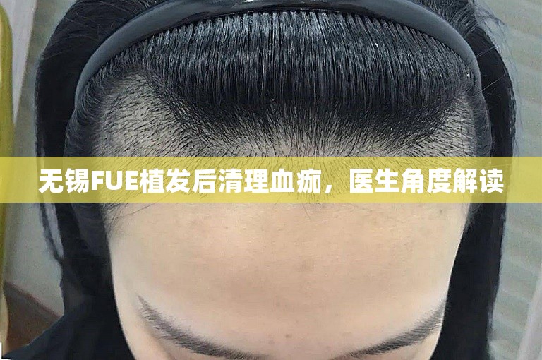 无锡FUE植发后清理血痂，医生角度解读