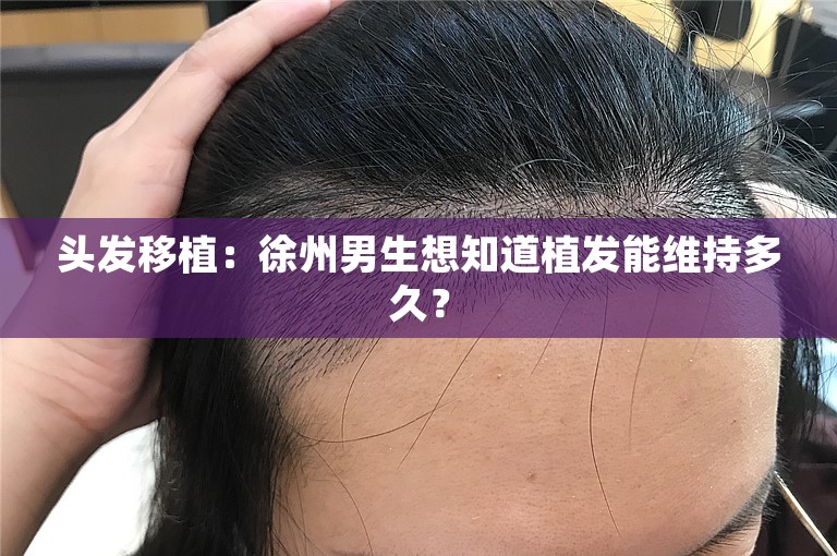 头发移植：徐州男生想知道植发能维持多久？