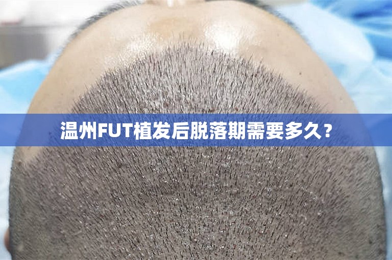 温州FUT植发后脱落期需要多久？