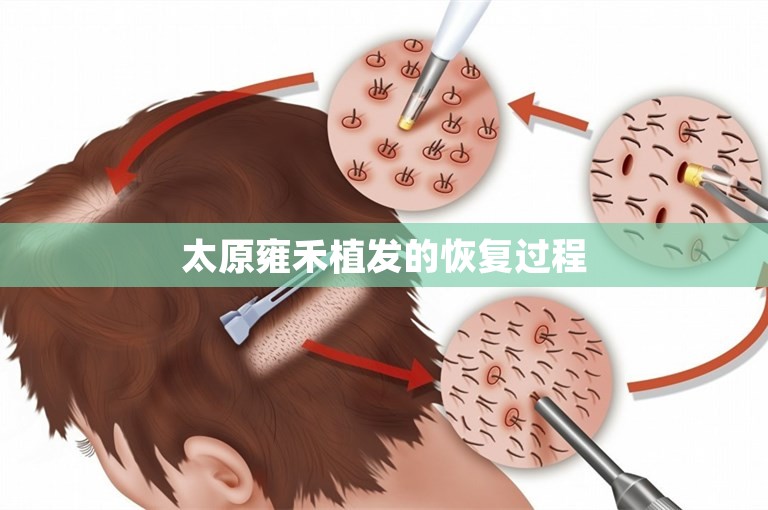 太原雍禾植发的恢复过程