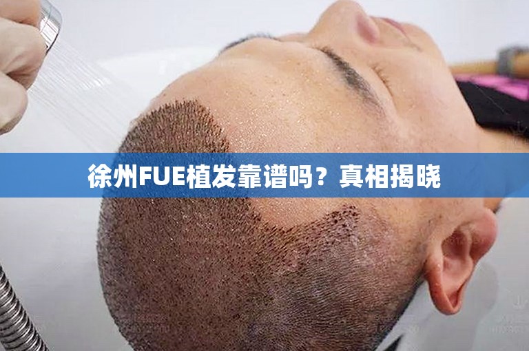 徐州FUE植发靠谱吗？真相揭晓