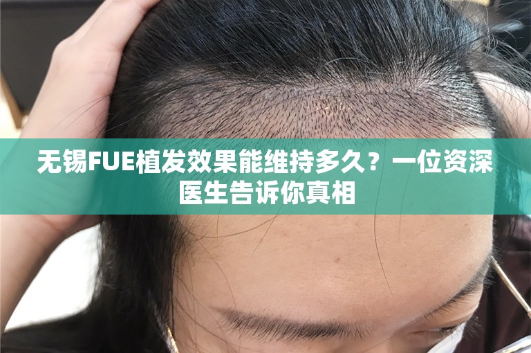 无锡FUE植发效果能维持多久？一位资深医生告诉你真相