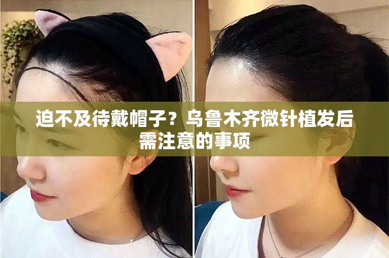 迫不及待戴帽子？乌鲁木齐微针植发后需注意的事项