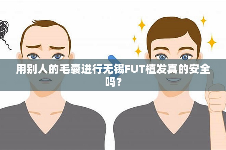 用别人的毛囊进行无锡FUT植发真的安全吗？