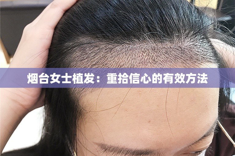 烟台女士植发：重拾信心的有效方法