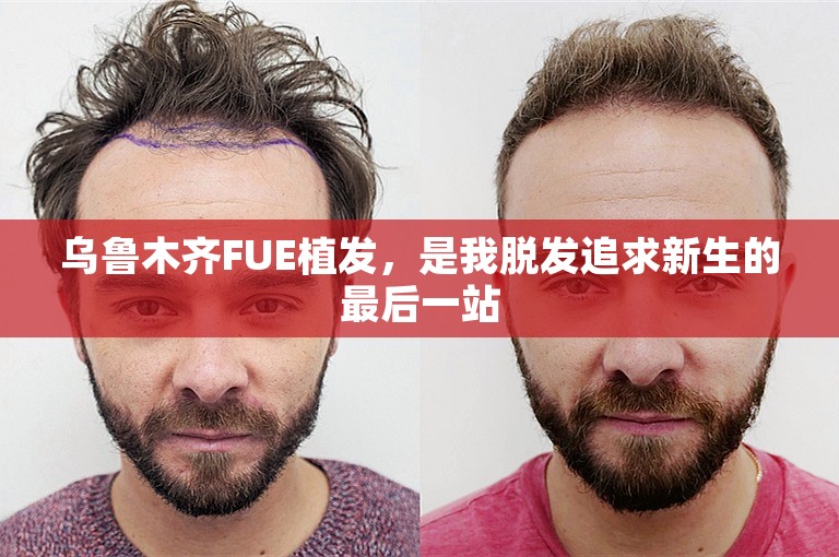 乌鲁木齐FUE植发，是我脱发追求新生的最后一站