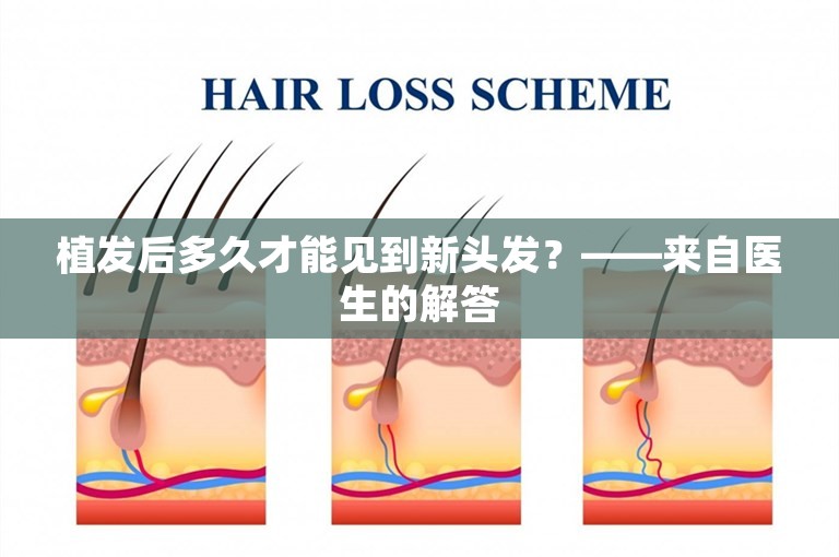 植发后多久才能见到新头发？——来自医生的解答