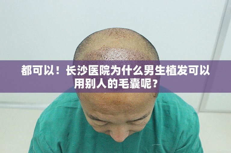 都可以！长沙医院为什么男生植发可以用别人的毛囊呢？