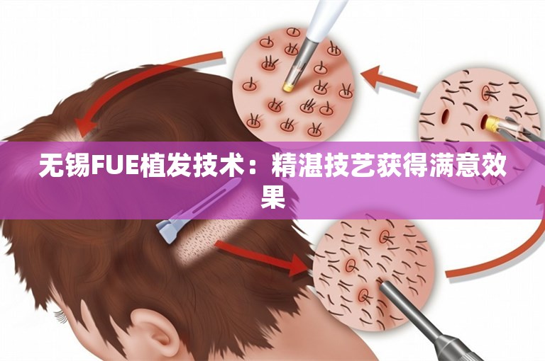 无锡FUE植发技术：精湛技艺获得满意效果