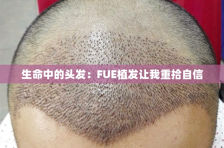 生命中的头发：FUE植发让我重拾自信