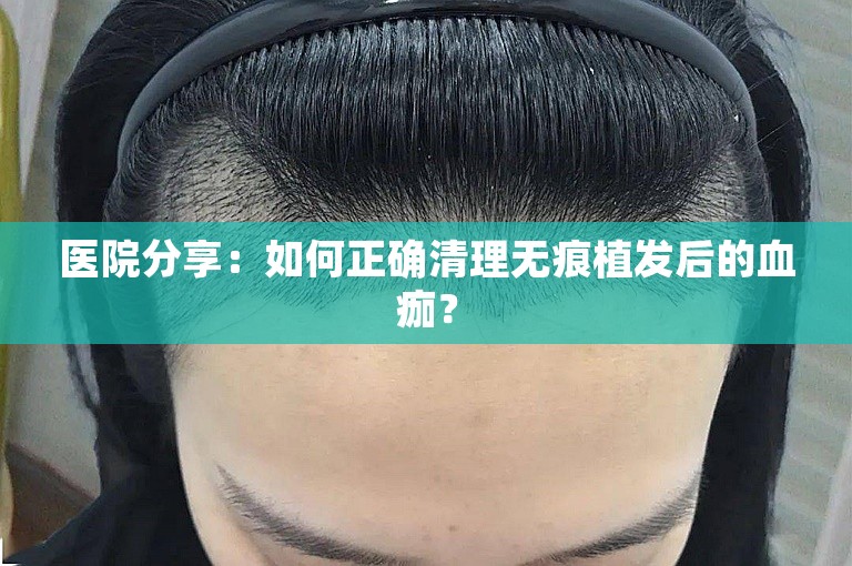 医院分享：如何正确清理无痕植发后的血痂？