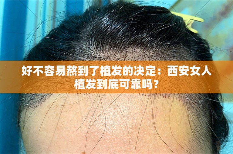 好不容易熬到了植发的决定：西安女人植发到底可靠吗？