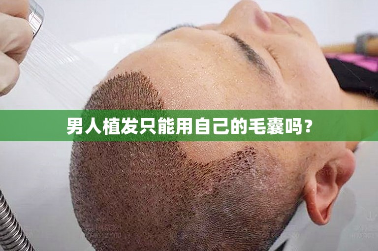 男人植发只能用自己的毛囊吗？