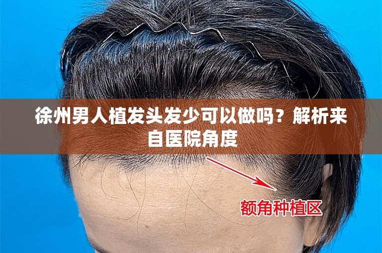 徐州男人植发头发少可以做吗？解析来自医院角度