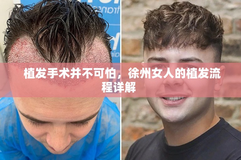  植发手术并不可怕，徐州女人的植发流程详解 