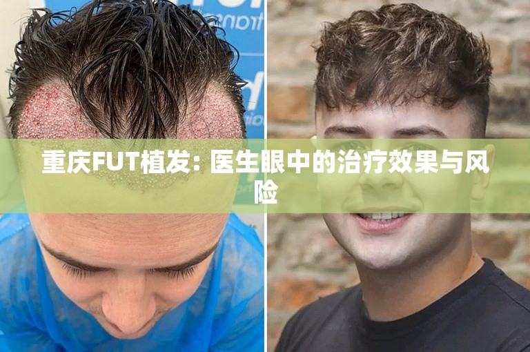 重庆FUT植发: 医生眼中的治疗效果与风险