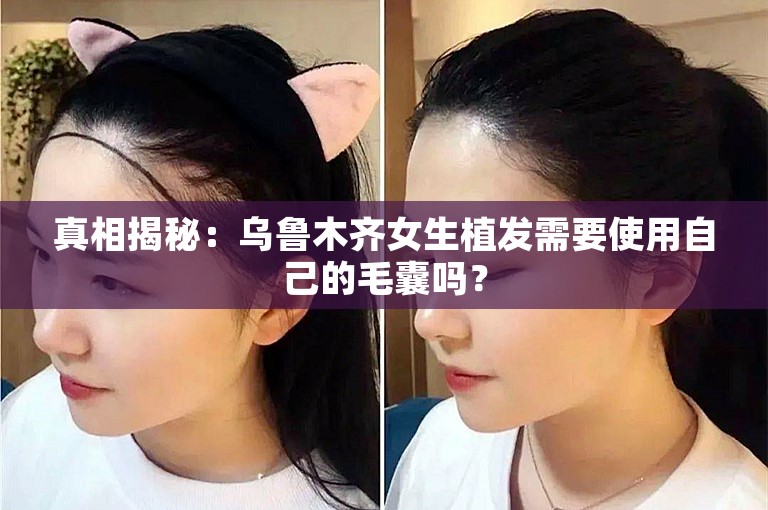 真相揭秘：乌鲁木齐女生植发需要使用自己的毛囊吗？