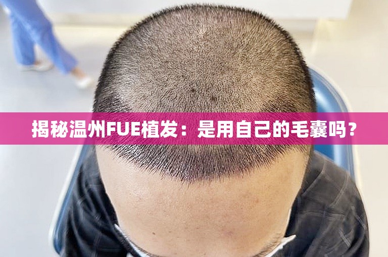 揭秘温州FUE植发：是用自己的毛囊吗？