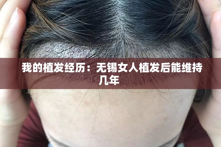  我的植发经历：无锡女人植发后能维持几年 