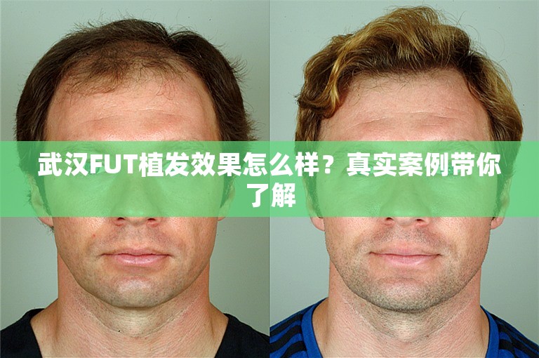 武汉FUT植发效果怎么样？真实案例带你了解