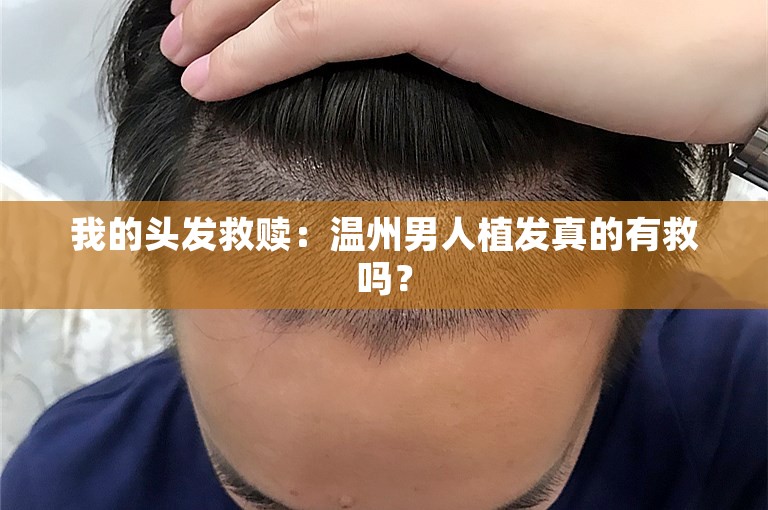 我的头发救赎：温州男人植发真的有救吗？