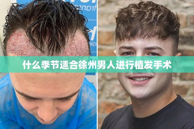 什么季节适合徐州男人进行植发手术