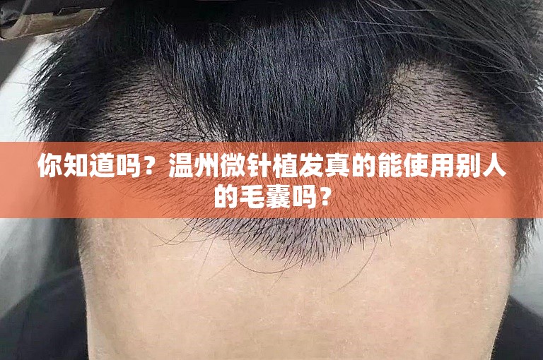 你知道吗？温州微针植发真的能使用别人的毛囊吗？