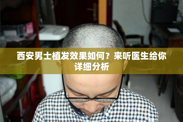 西安男士植发效果如何？来听医生给你详细分析