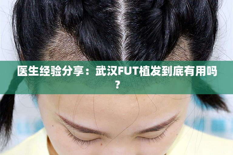 医生经验分享：武汉FUT植发到底有用吗？