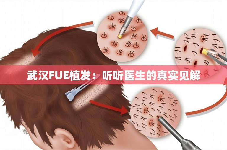 武汉FUE植发：听听医生的真实见解