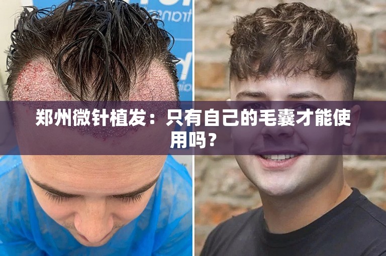 郑州微针植发：只有自己的毛囊才能使用吗？