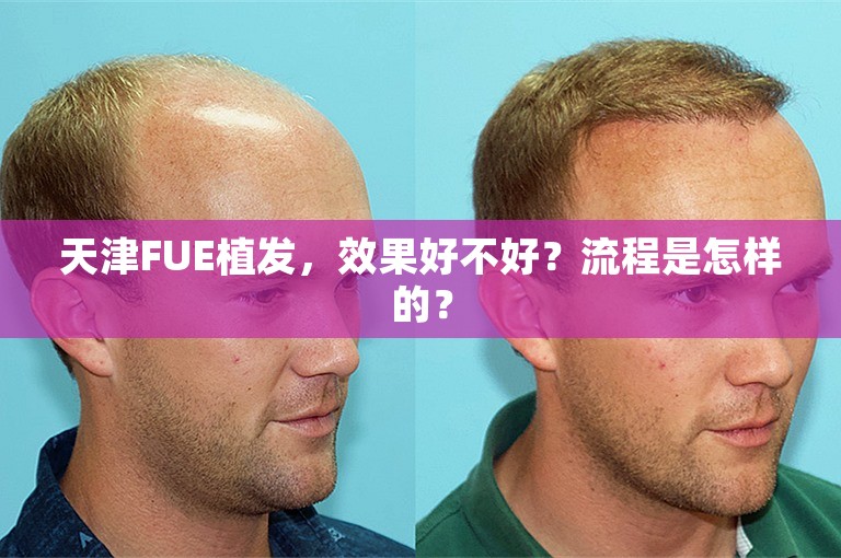 天津FUE植发，效果好不好？流程是怎样的？