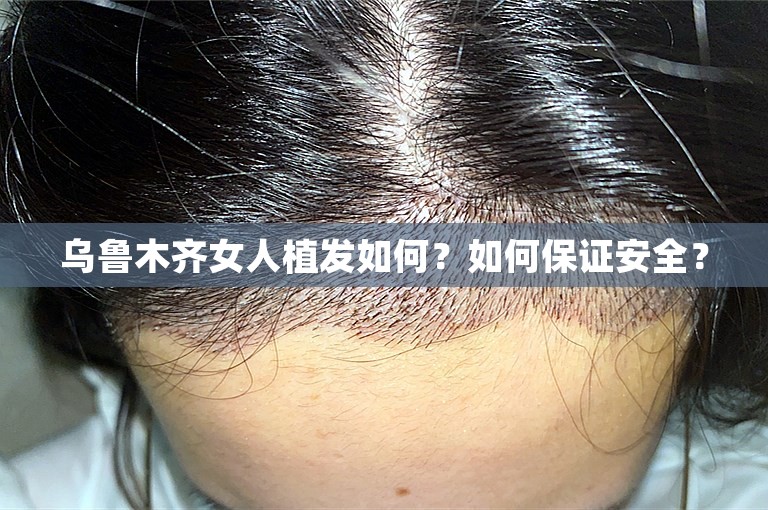 乌鲁木齐女人植发如何？如何保证安全？