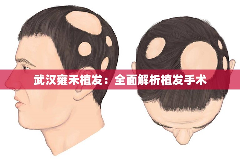 武汉雍禾植发：全面解析植发手术